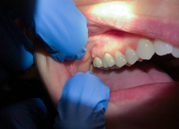 Best Emergency Dentist for Lost Fillings or Crowns in Fairview, NY